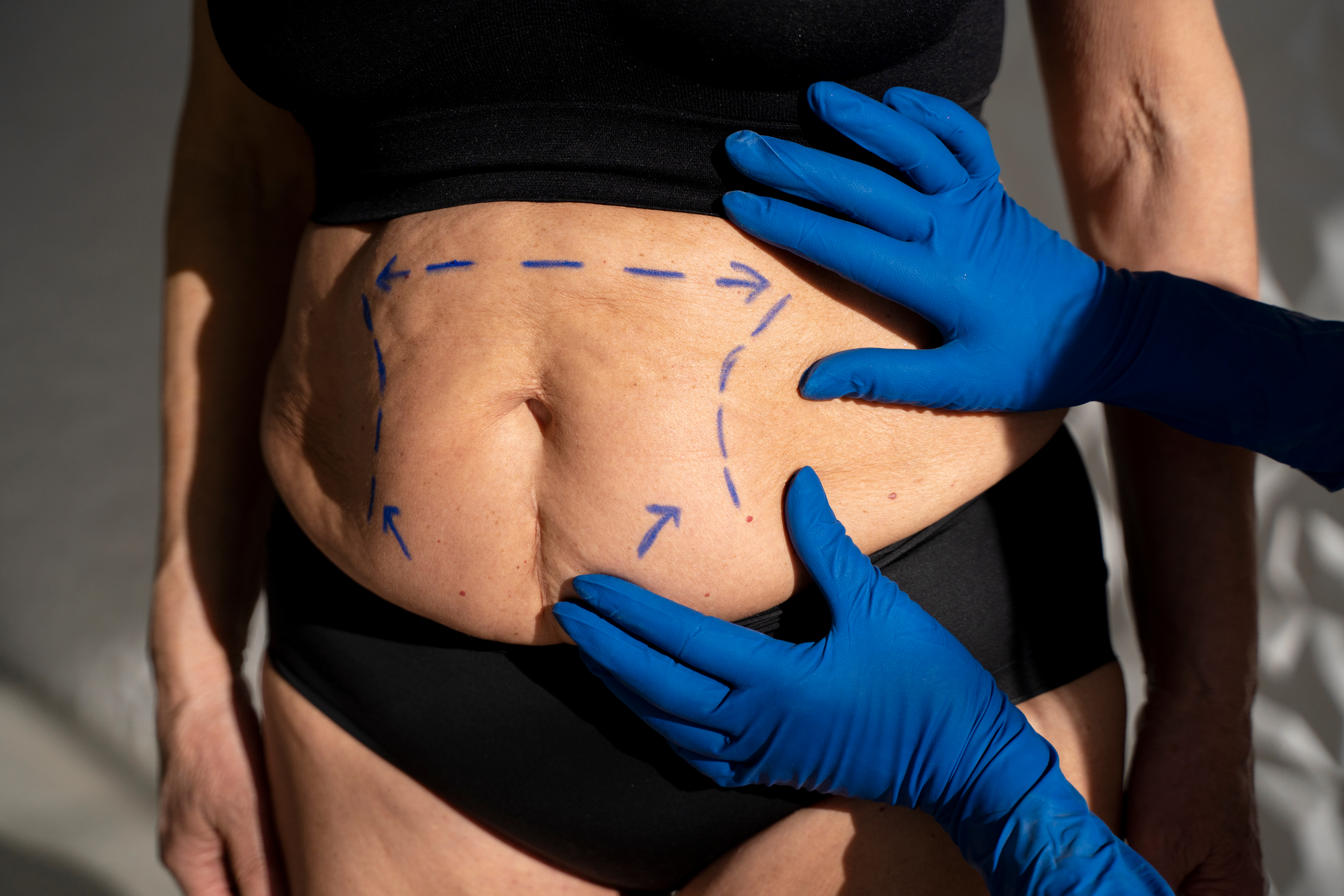 Lipoabdominoplastia