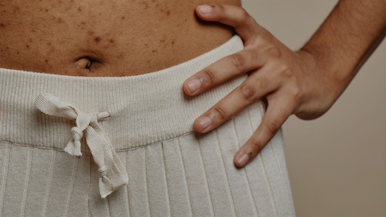 Como fica o umbigo após a abdominoplastia? - Dr. Marcus Calazans - Goiânia