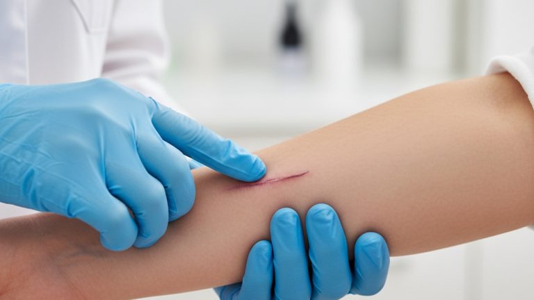 Cuidados Essenciais com a Cicatriz nos Primeiros 30 Dias Pós-Cirúrgicos